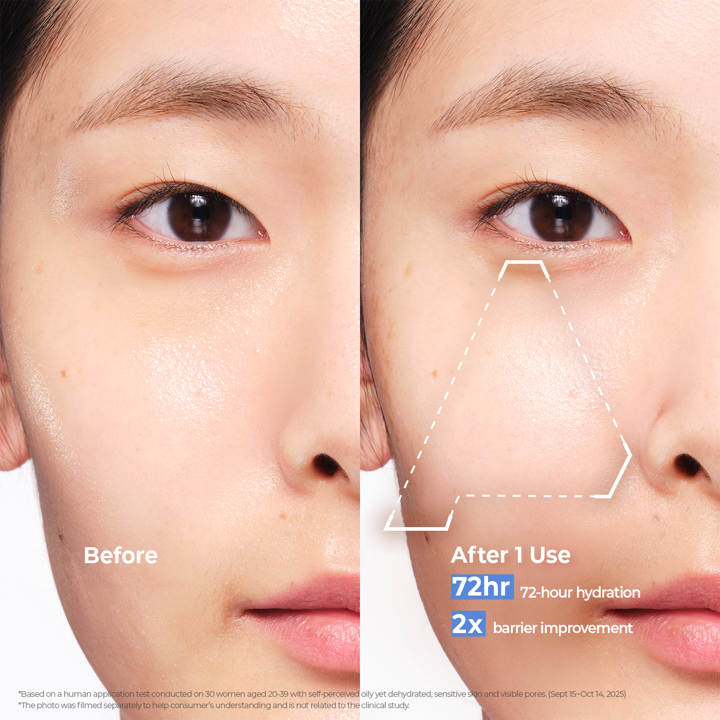 Before and after comparison of skin improvement with Aestura cream