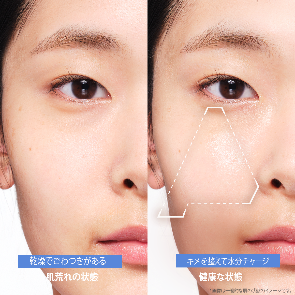 Before and after comparison of skin improvement with Aestura cream