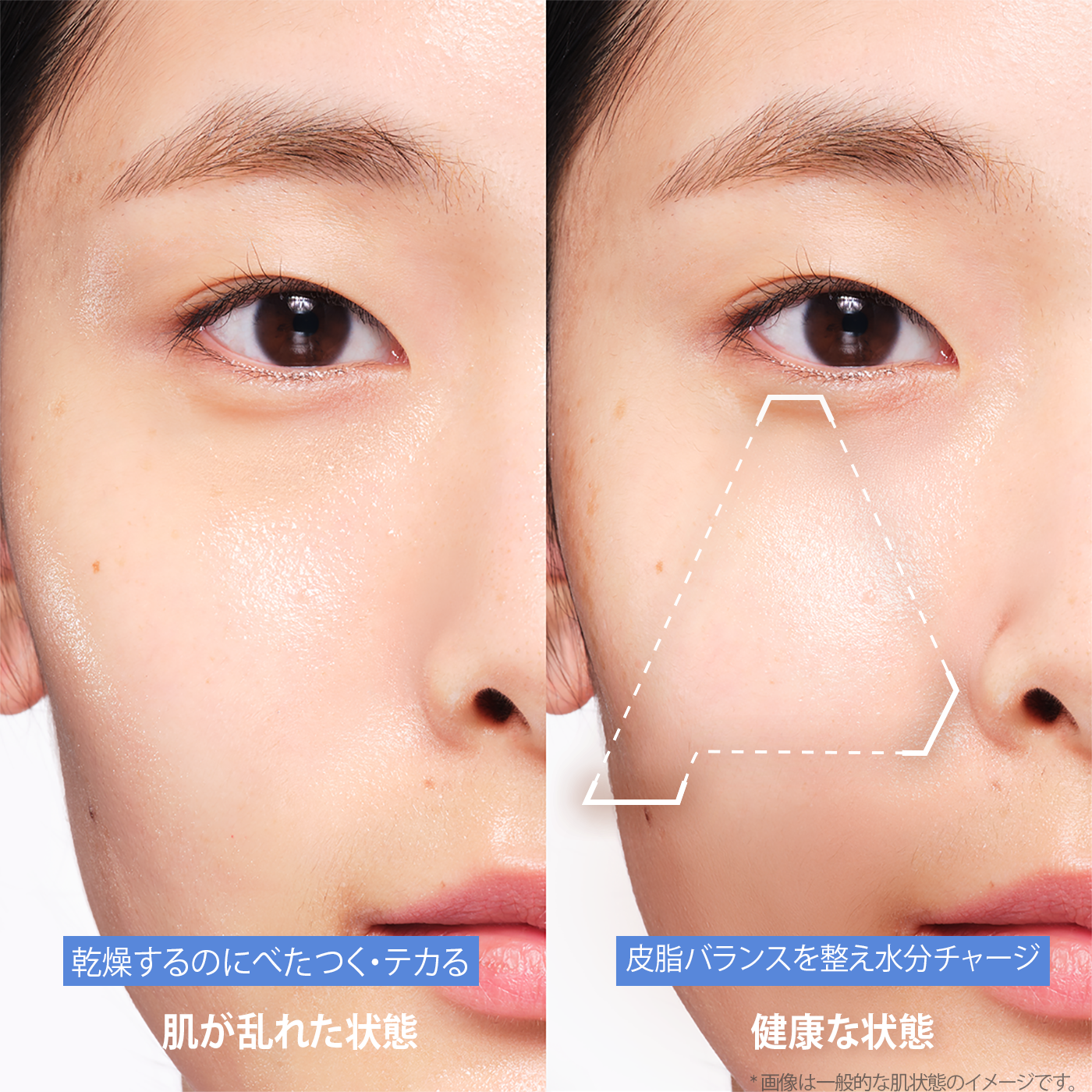 Before and after comparison of skin improvement with Aestura cream