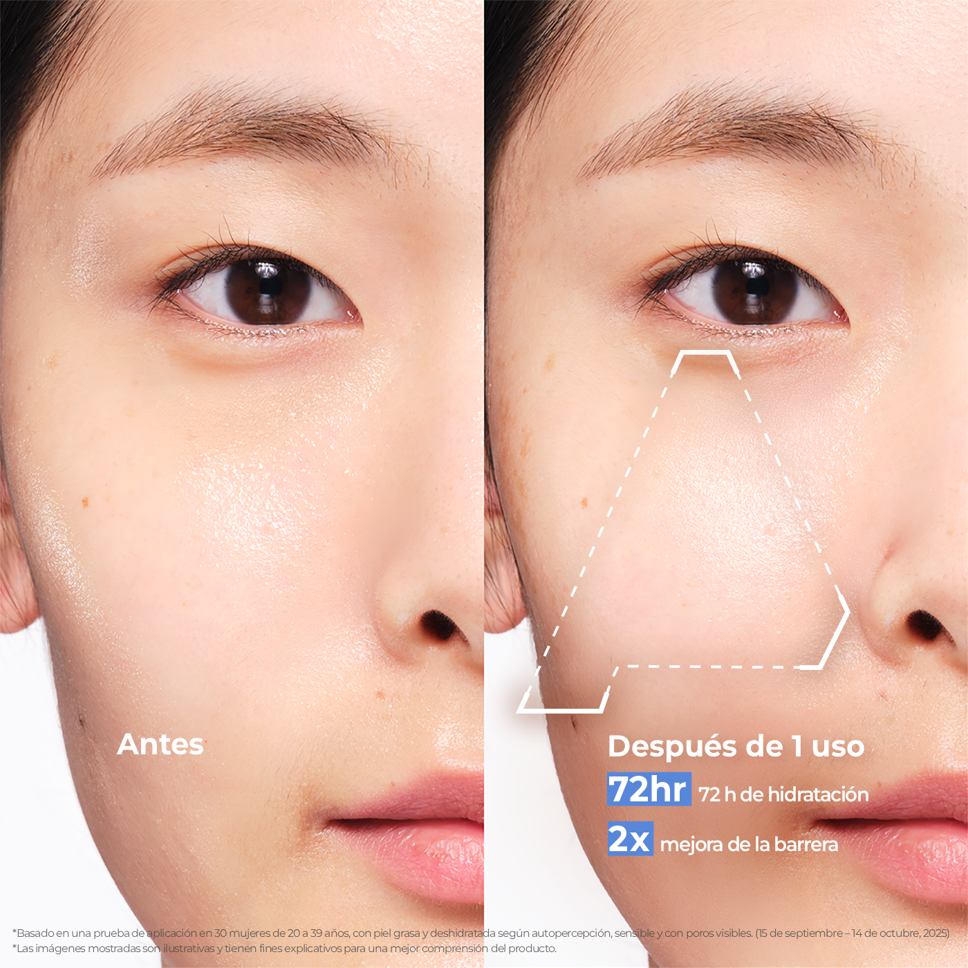 Before and after comparison of skin improvement with Aestura cream