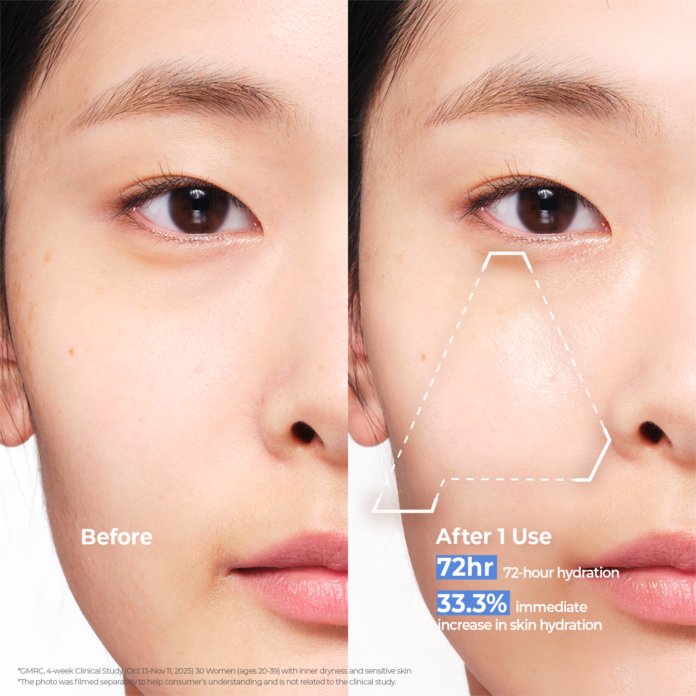 Before and after comparison of skin improvement with Aestura cream